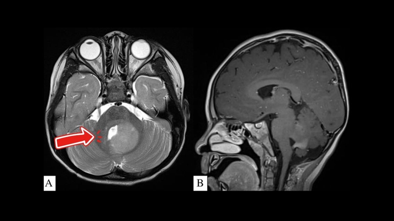 U tiểu não: Triệu chứng nhận biết, phác đồ điều trị và tiên lượng bệnh 1
