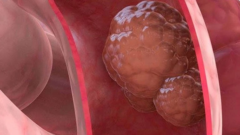 U trực tràng ác tính và những điều cần biết 5