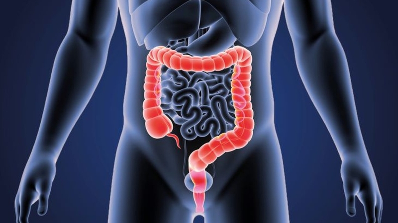 U trực tràng ác tính và những điều cần biết 2