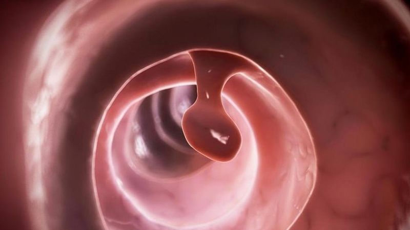 U trực tràng lành tính có nguy hiểm không? 4