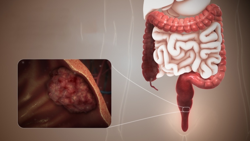 U trực tràng và những điều bạn cần biết 2