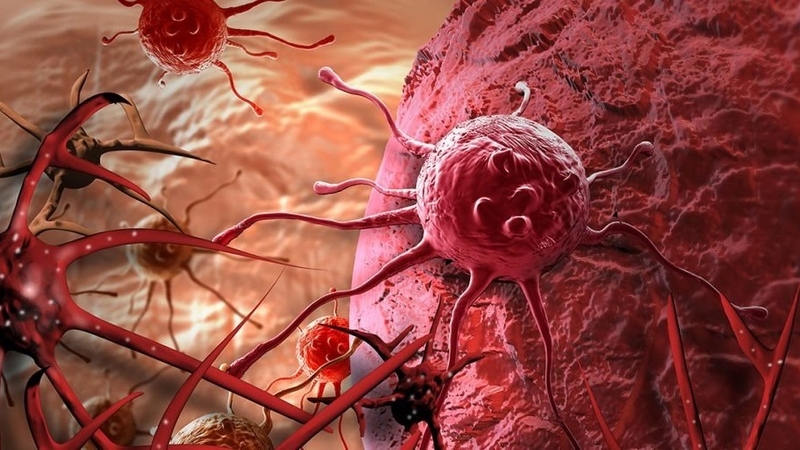 U tụy ác tính 02