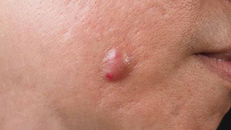 U tuyến bã nhờn: Biểu hiện, nguyên nhân và cách điều trị 1