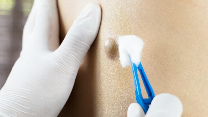 Hạt đậu dưới da: Giải đáp từ chuyên gia 2