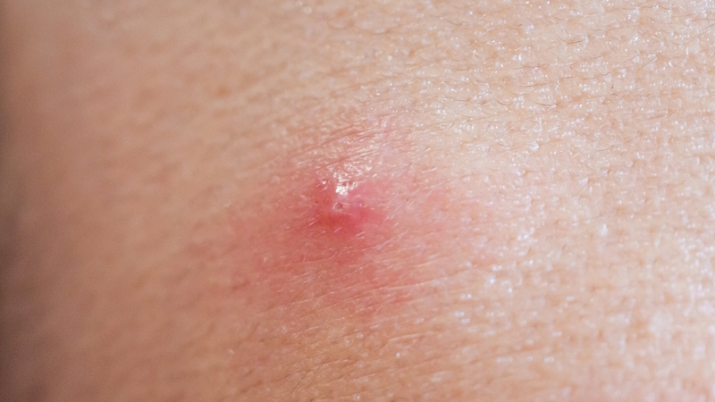 Hạt đậu dưới da: Giải đáp từ chuyên gia 3