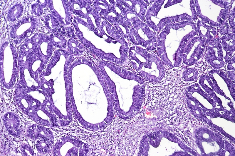 U tuyến ống nghịch sản độ cao ở đại tràng có phải ung thư không? 3