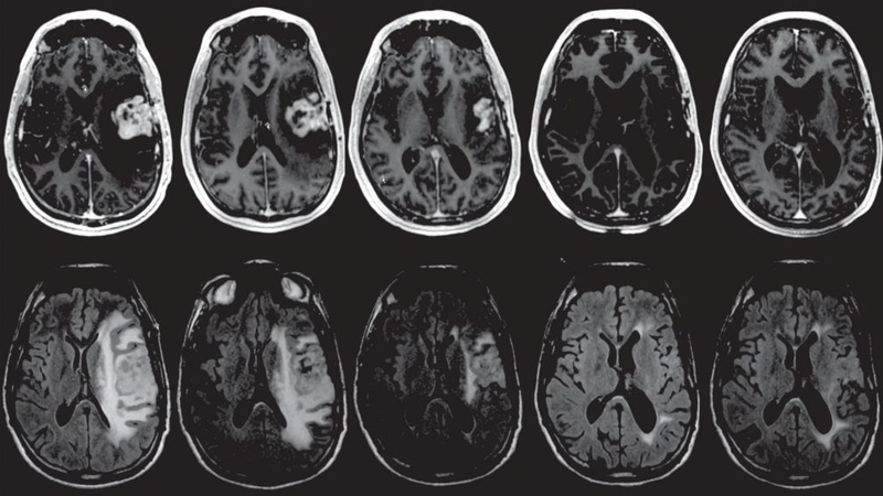 U tuyến thượng thận: Phân loại, nguyên nhân và các cách điều trị 2