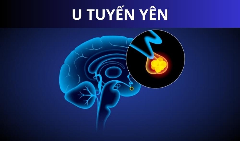 U tuyến yên có nguy hiểm không và cách phòng ngừa 1