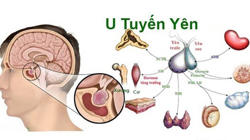 U tuyến yên tăng tiết prolactin là gì và cách điều trị hiệu quả 1