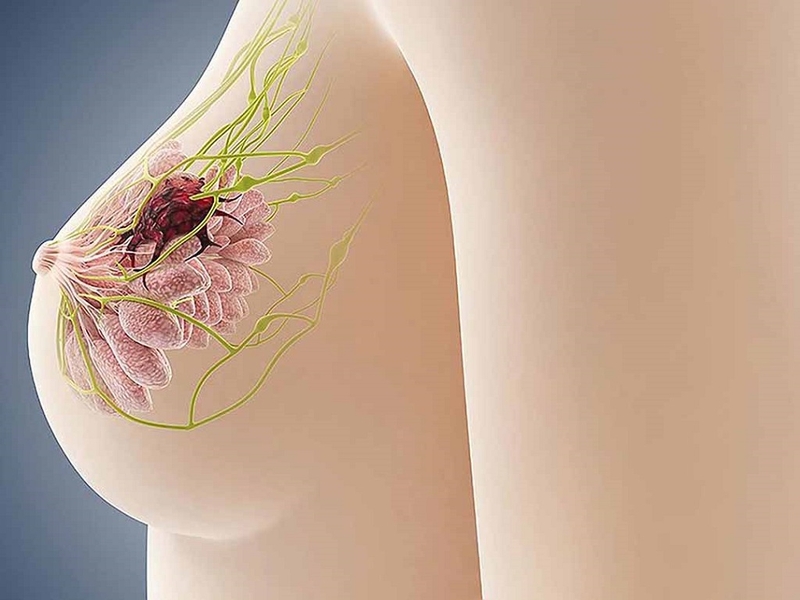 U vú lành tính và ung thư vú: Cách phân biệt và nhận biết mà chị em cần biết 1