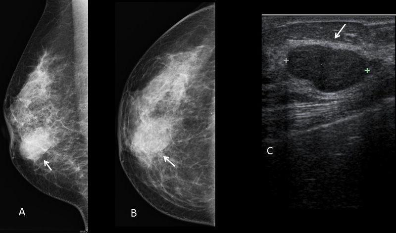 Nổi cục ở nhũ hoa: Dấu hiệu u lành tính và u ác tính 3