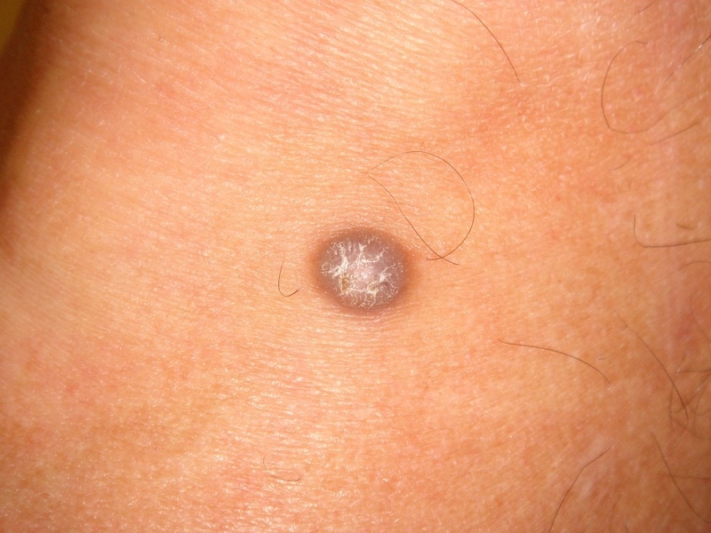 U xơ dưới da là gì? Cách phân biệt với u mỡ dưới da