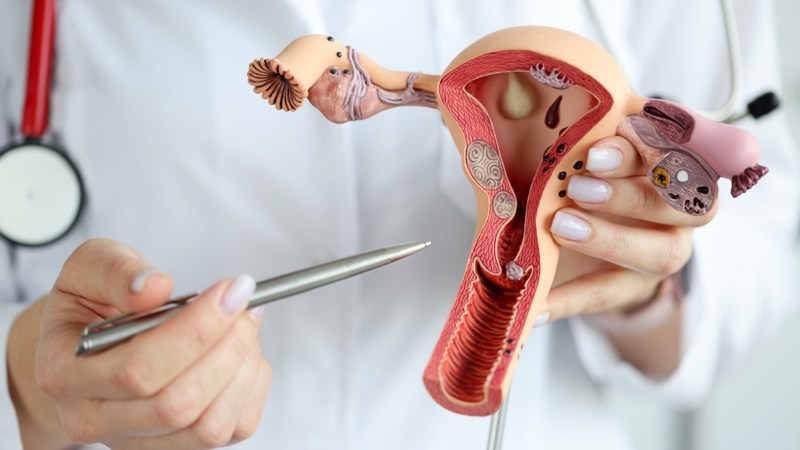 U xơ tử cung 86mm có nguy hiểm không? Phương án điều trị u xơ tử cung kích thước lớn 3