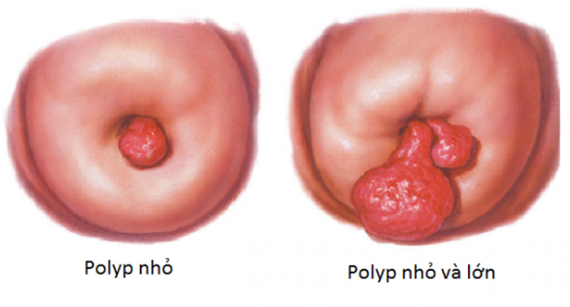 U xơ tử cung bị rong kinh phải làm sao?2