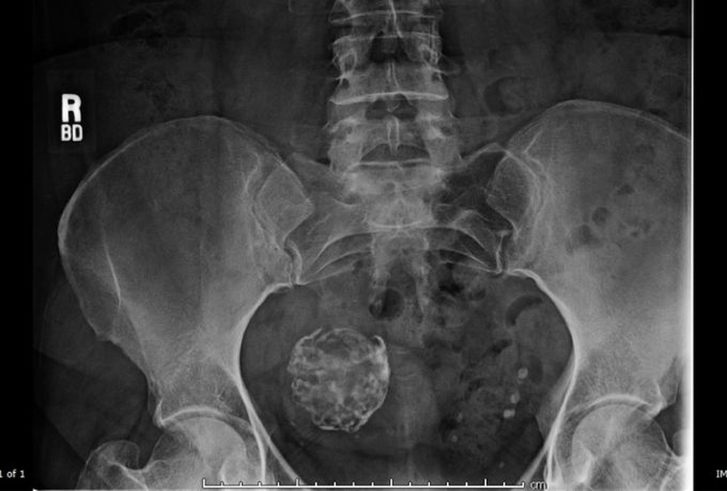 Sự nguy hiểm của tình trạng u xơ tử cung bị vôi hóa 5