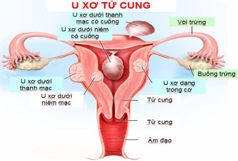 U xơ tử cung khi mang thai có gây nguy hiểm? 1
