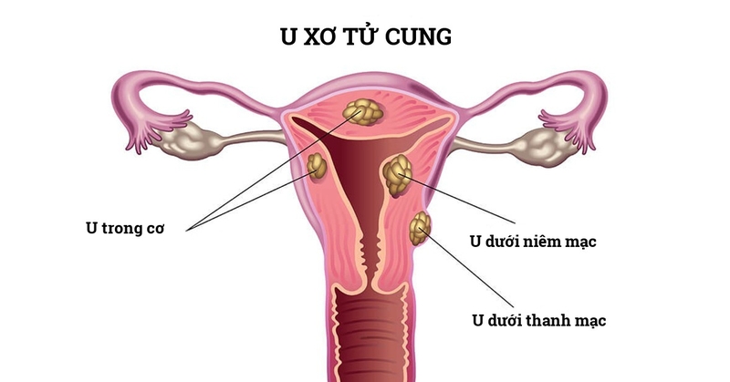U xơ tử cung là hiện tượng xuất hiện các khối u ở tử cung