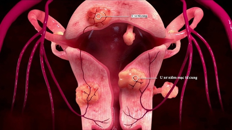 U xơ tử cung ở độ tuổi nào mắc nhiều nhất? 1