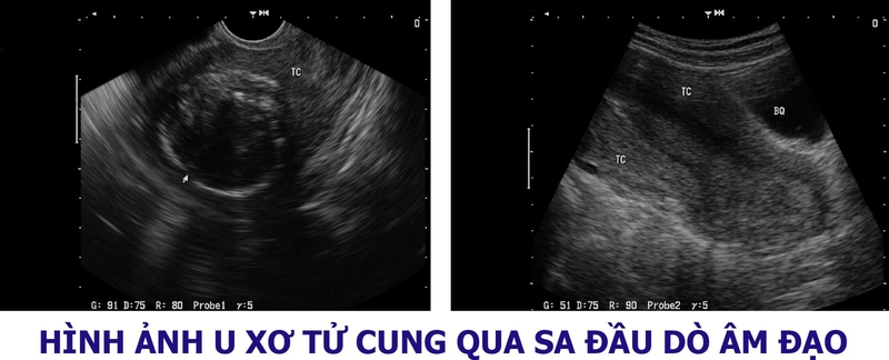 U xơ tử cung qua siêu âm đầu dò âm đạo