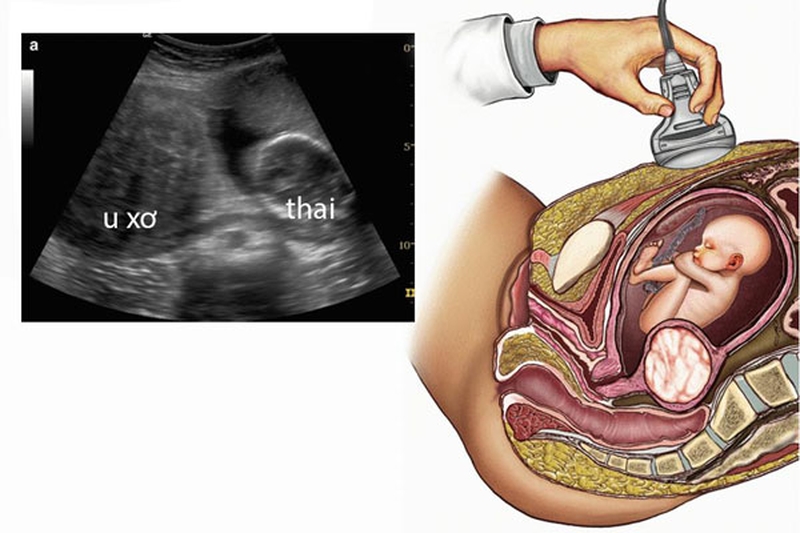 Sự tác động giữa u xơ tử cung và thai nghén 5