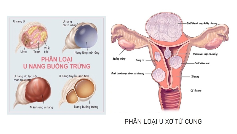 u-xo-tu-cung-va-u-nang-buong-trung-3.jpg