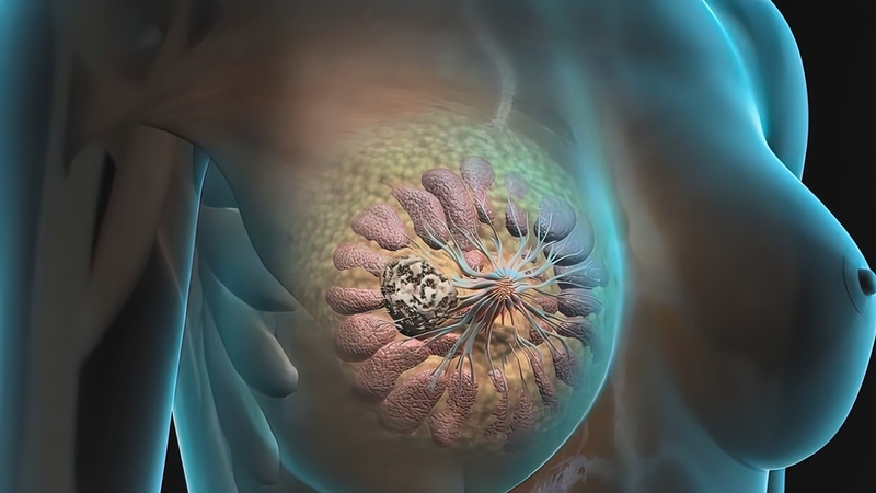 U xơ tuyến vú có nguy hiểm không Có để lại biến chứng không 1