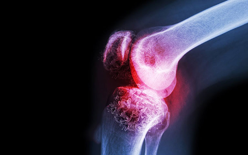 Tìm hiểu chung: Dấu hiệu của U xương ác tính 1