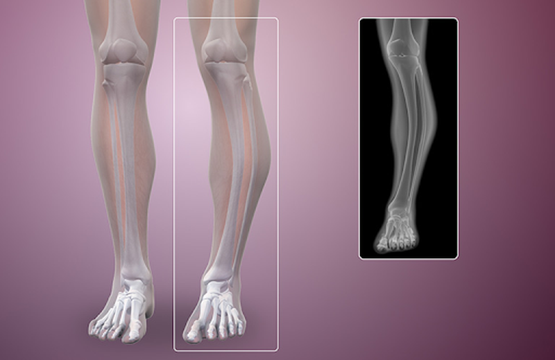 Tìm hiểu chung: Dấu hiệu của U xương ác tính 2