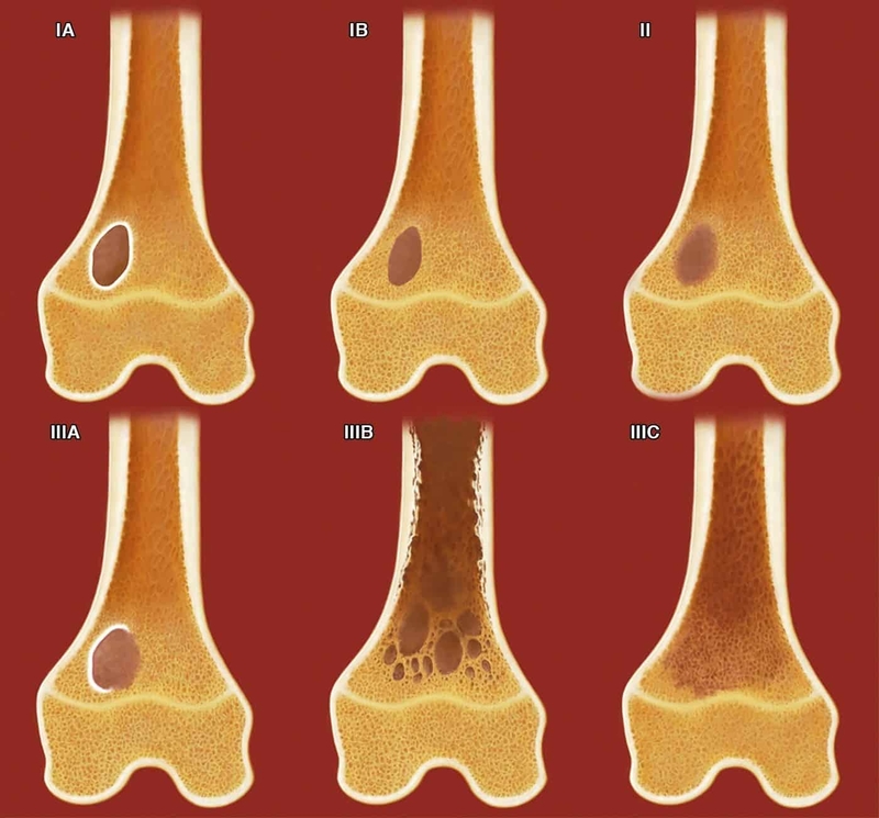 U xương lành tính có nguy hiểm không? 1