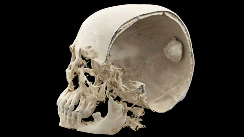 U xương sọ là gì? Cách điều trị u xương sọ 1