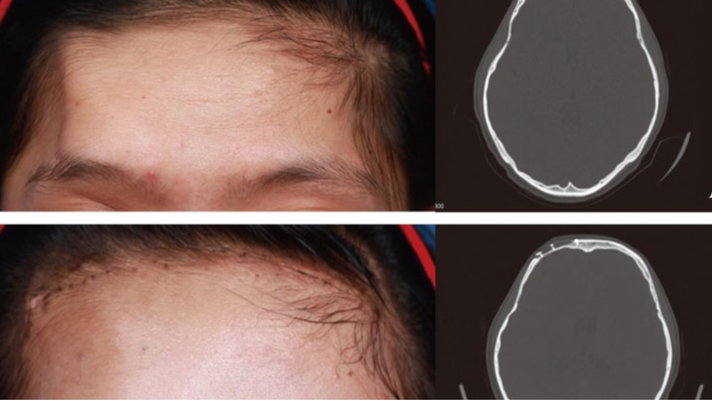 U xương sọ là gì? Cách điều trị u xương sọ 3