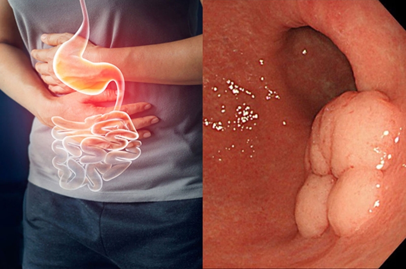 benh-ung-thu-da-day-co-chua-duoc-khong-3