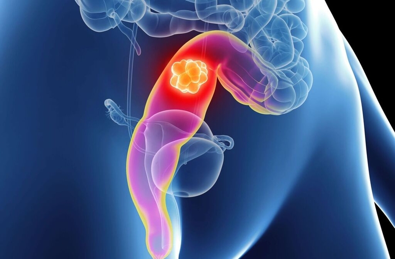 Ung thư biểu mô đại tràng: Nguyên nhân, chẩn đoán và phương pháp điều trị 3