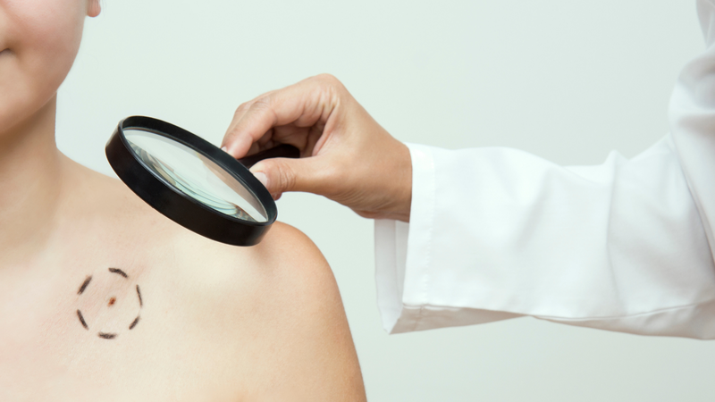 Ung thư biểu mô tế bào vảy là loại ung thư da phổ biến