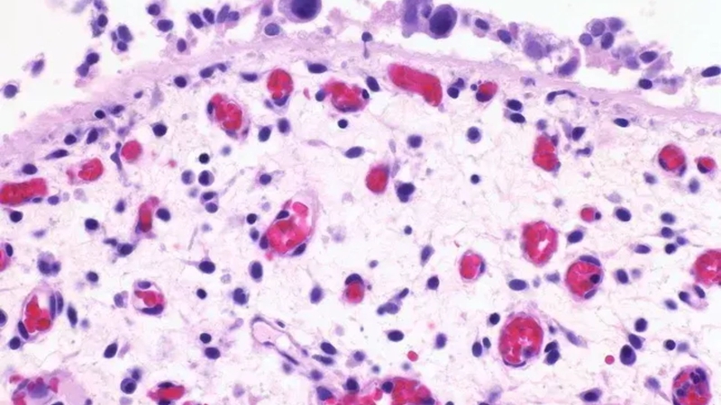 Ung thư biểu mô tại chỗ (Carcinoma in situ - CIS) là ung thư giai đoạn 0