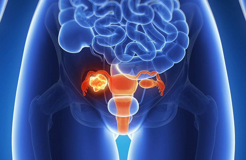 Ung thư buồng trứng sống được bao lâu - Đọc ngay! 2