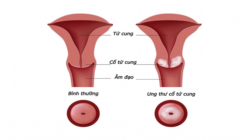 Ung thư cổ tử cung di căn phổi gây ra những biến chứng gì?