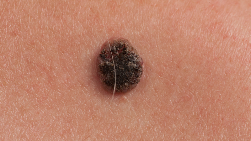 Ung thư da có chết không? Mức độ nguy hiểm phụ thuộc vào loại ung thư, giai đoạn phát hiện và cách điều trị