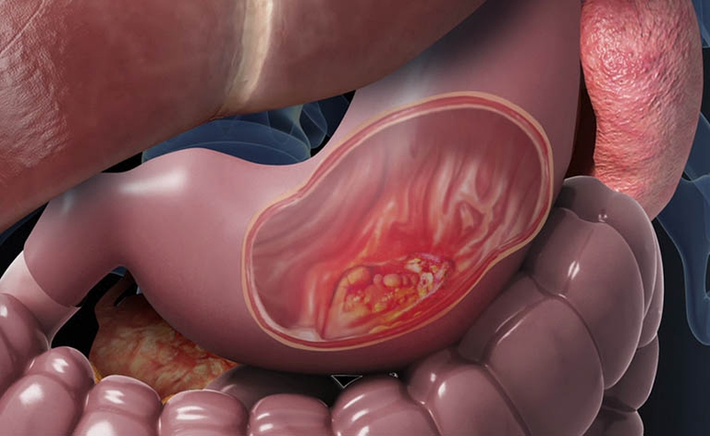 7 Dấu hiệu ung thư dạ dày mà ai cũng nên biết 1