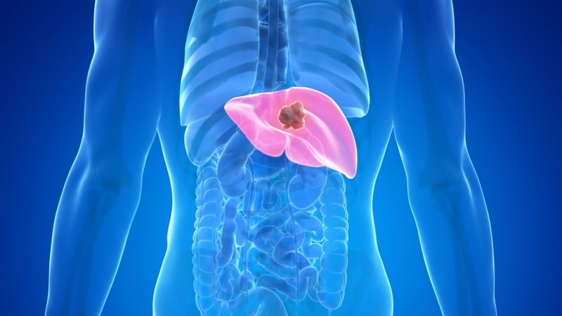 Di căn gan là thể di căn phổ biến nhất trong ung thư dạ dày giai đoạn tiến xa