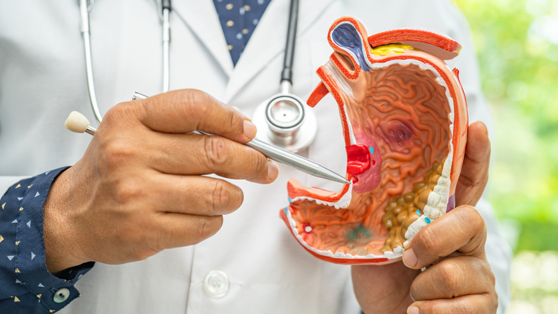 Ung thư dạ dày giai đoạn 1: Triệu chứng, tiên lượng, chẩn đoán và điều trị 1