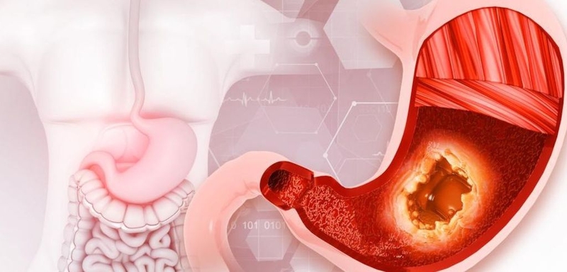 ung thư dạ dày thường di căn đến đâu điều trị thế nào 2