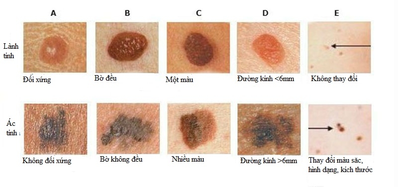 Ung thư da giai đoạn đầu có chữa được không? 3