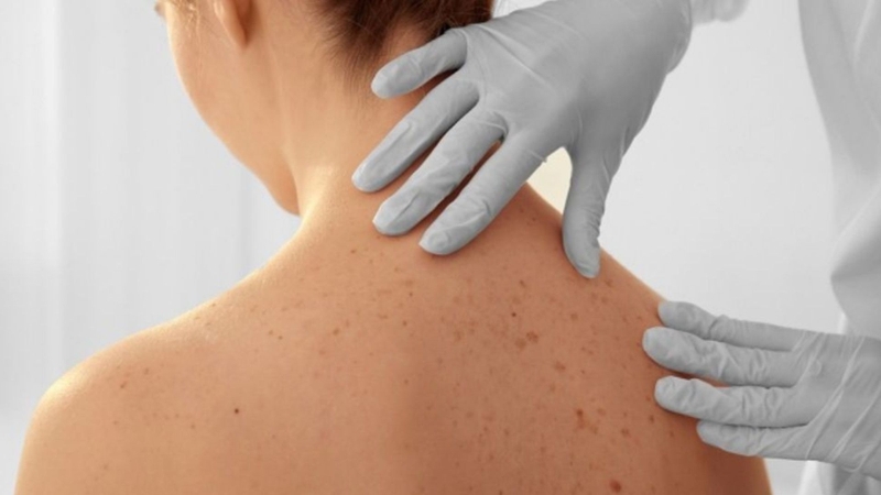 Ung thư da lành tính là gì? Nguyên nhân và cách điều trị 1