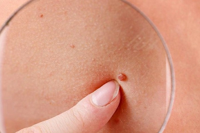 Ung thư da mặt có nguy hiểm không? 2