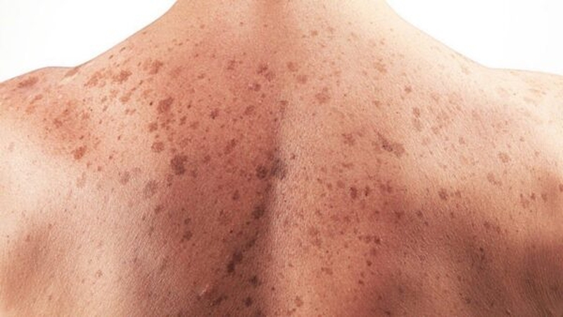 Ung thư da thường gặp ở độ tuổi nào? 1