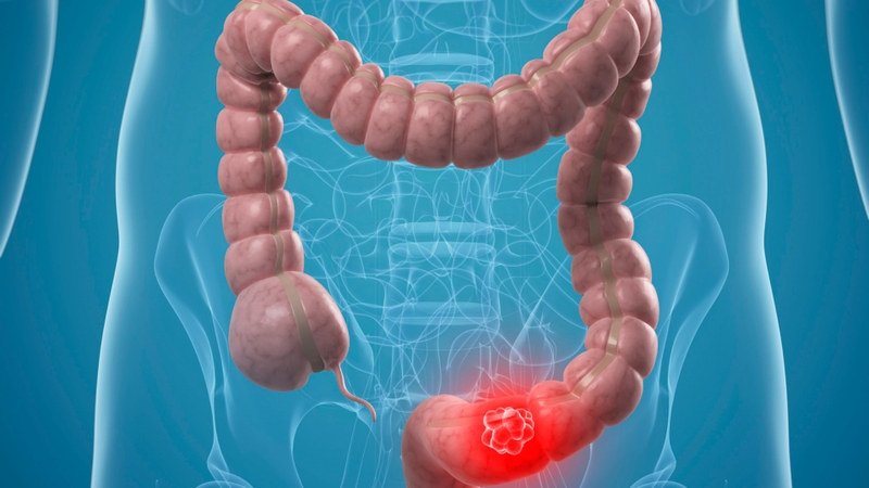 Ung thư đại tràng giai đoạn 1 là giai đoạn sớm, khả năng điều trị thành công rất cao