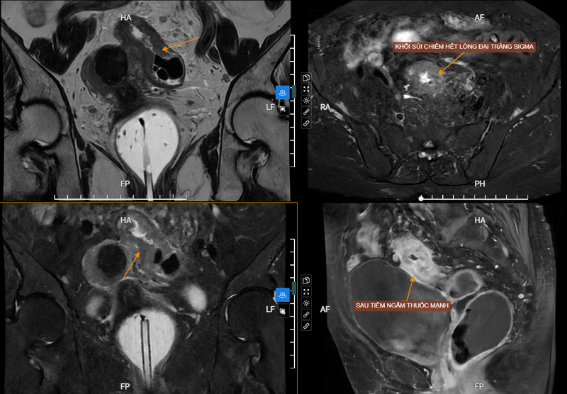 Ung thư đại tràng sigma: Nguyên nhân, dấu hiệu và cách điều trị 2