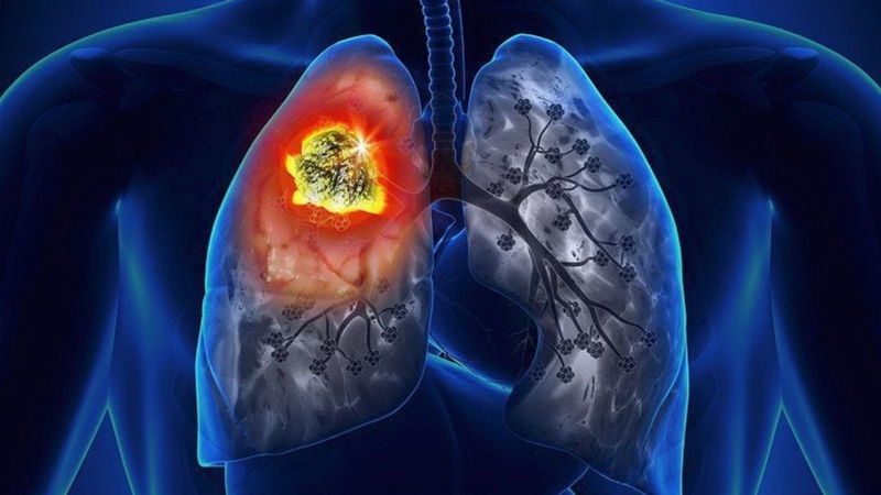 Ung thư di căn có chữa được không?