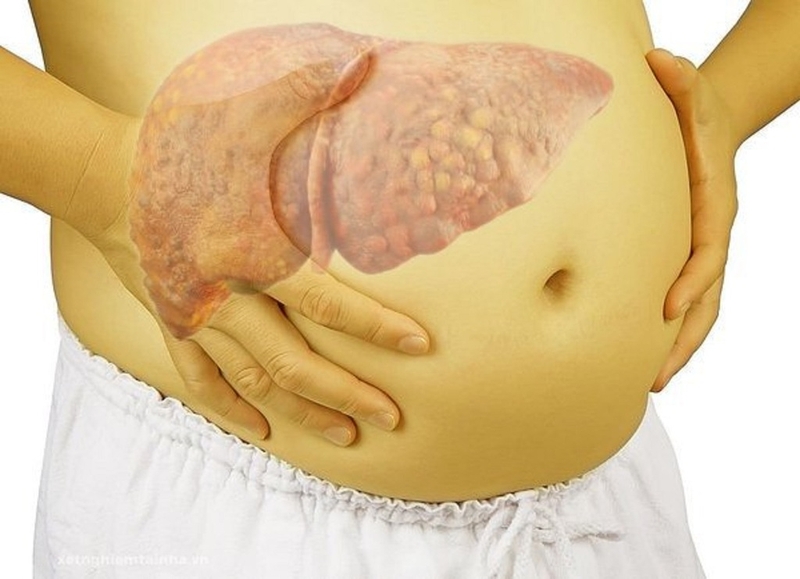 Ung thư gan giai đoạn 4: Triệu chứng, tiên lượng, phương pháp chẩn đoán và điều trị 2